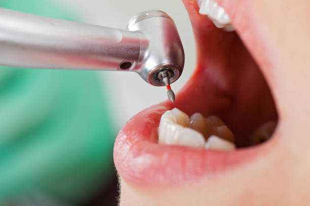 Best Emergency Root Canal Treatment in West Hazleton, PA